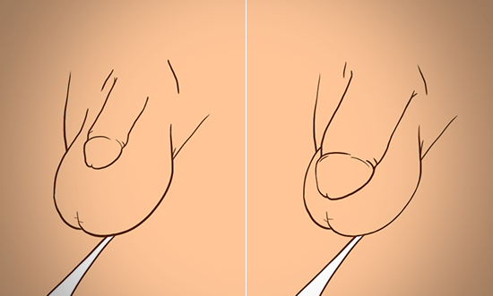 하이맨 대체진피/저장진피 음경확대 수술 전/후 입니다.