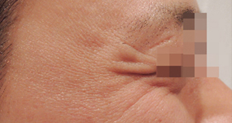 눈가 보톡스 시술전